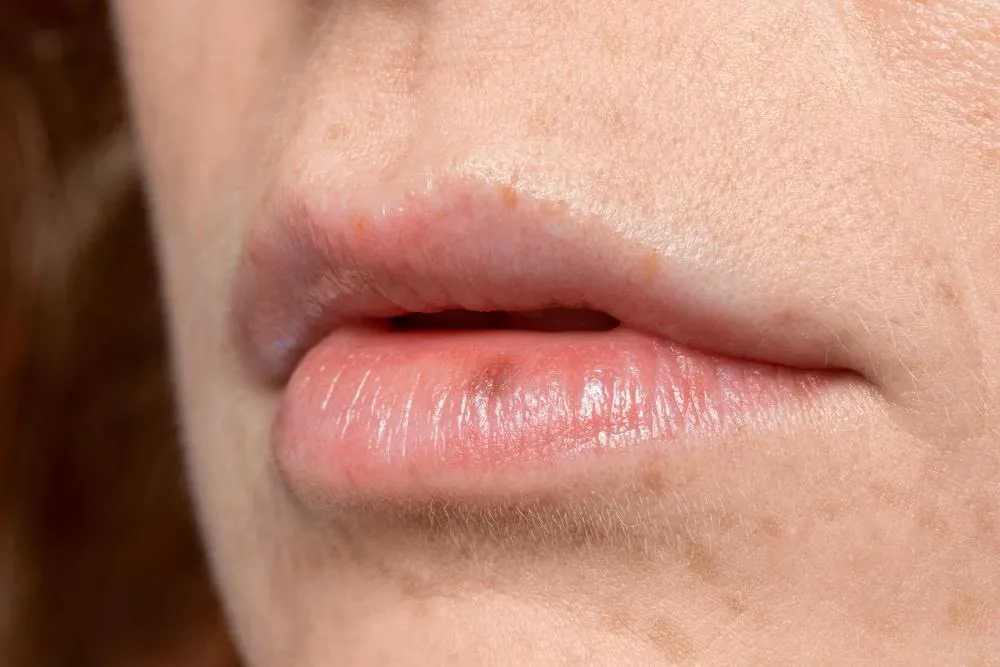 Bibir Kering dan Mengelupas: 7 Penyebab Utama dan Cara Mencegahnya