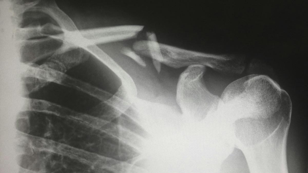 Hari Osteoporosis Sedunia: Saatnya Menabung Kepadatan Tulang Sejak Muda