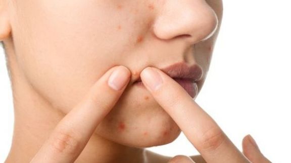 5 Tahapan Perawatan Lengkap untuk Kulit Berjerawat