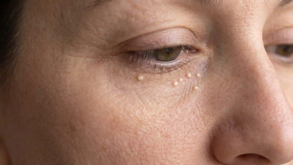 Kesalahan Mencabut Komedo dan Eksfoliasi yang Merusak Kulit: Panduan Aman dari Dermatolog