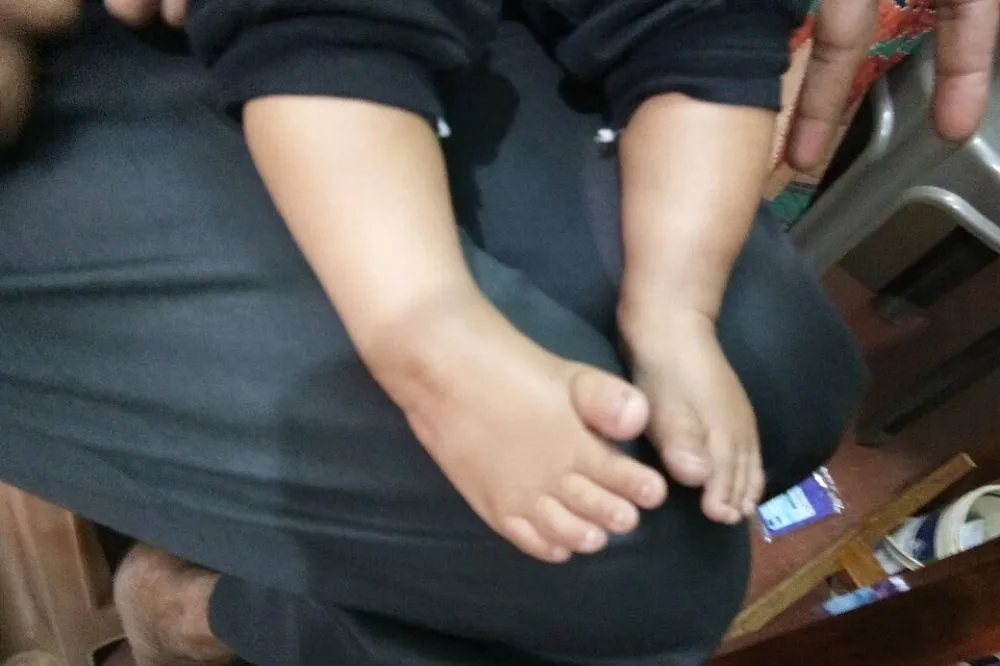 Kaki Bengkok Bawaan pada Bayi: Deteksi Dini dan Perawatan Jangka Panjang