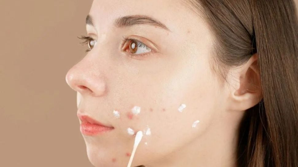 Sulfur vs Salicylic Acid untuk Jerawat: Mana yang Tepat?