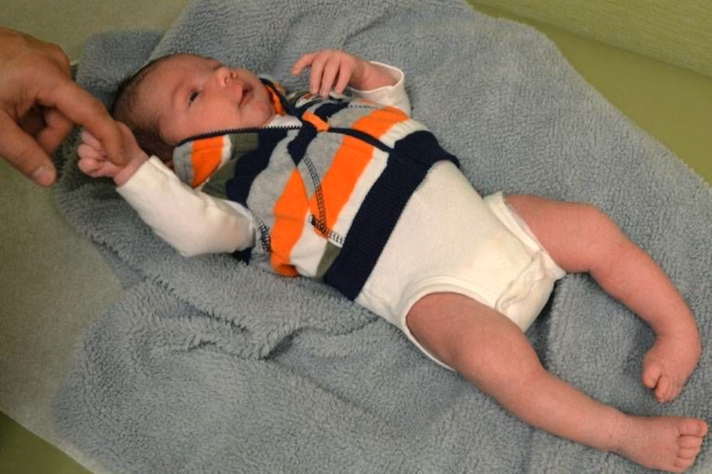 Kaki Bengkok Bawaan pada Bayi: Deteksi Dini dan Perawatan Jangka Panjang