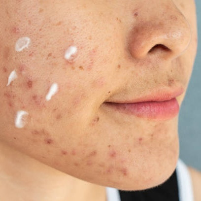 Intip Cara Kerja Obat Totol Jerawat, Kapan Harus Dipakai?