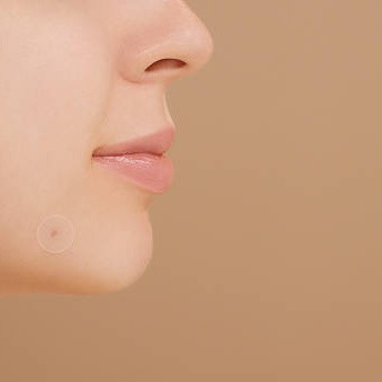 Cara dan Urutan Memakai Acne Patch yang Benar