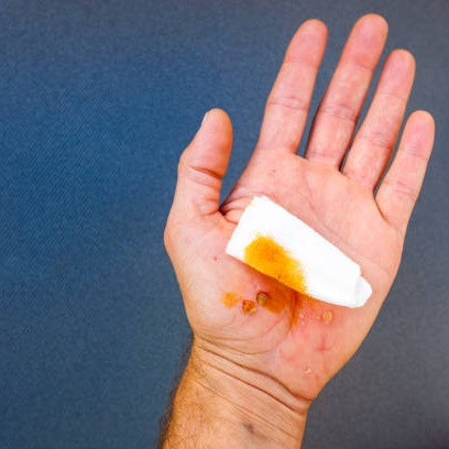 Salah Kaprah Pakai Antiseptik Pada Luka