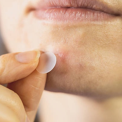 5 Kesalahan Pakai Acne Patch yang Bikin Nggak Efektif, Bikin Jerawat Makin Parah?