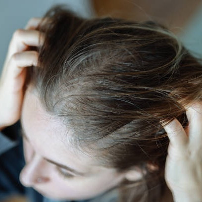 Memahami dan Mencegah Iritasi Kulit Kepala