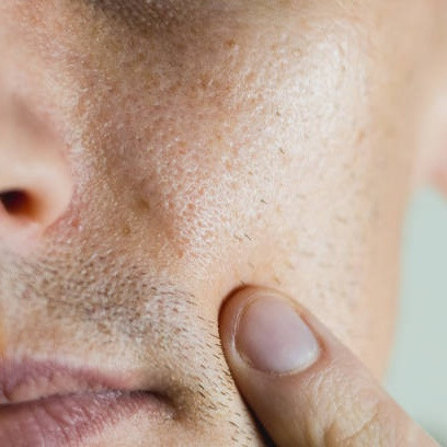 Mengupas Tuntas Wajah Berminyak pada Pria dan Cara Mengatasinya