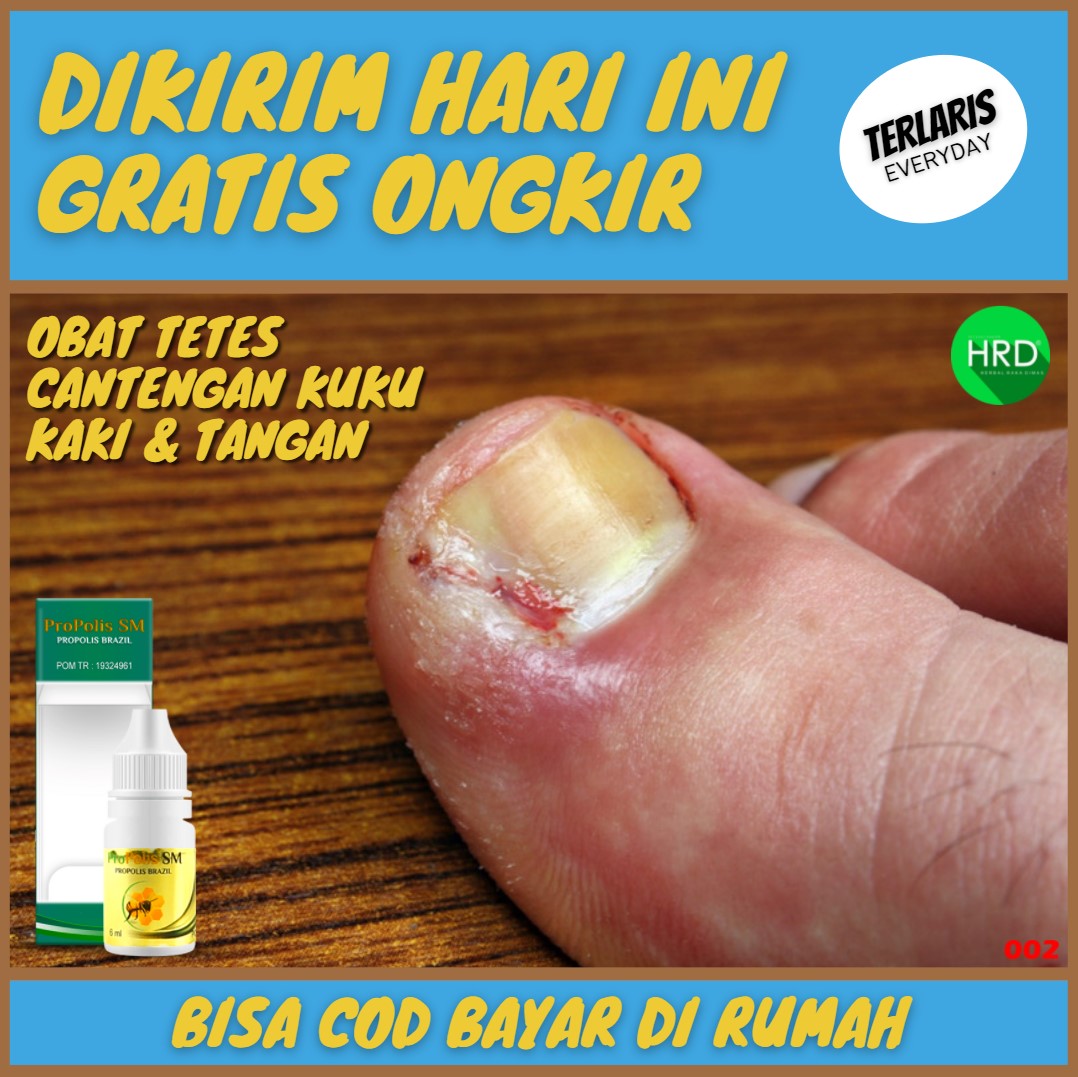 Obat Tetes Untuk Cantengan Kuku Jempol Kaki dan Jari Tangan yang di Oles Infeksi Jamur Parah Iritasi Bernanah Berdarah Sakit Nyeri Bengkak Kemerahan Keras Cedera Melengkung Menusuk ke Dalam Kulit Samp
