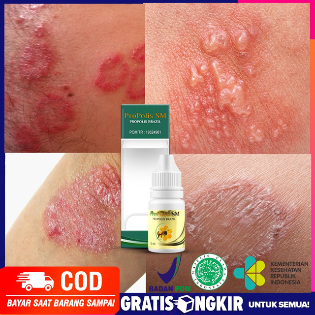 Obat Gatal Eksim Kudis atau skabies Cacar Kurap atau infeksi jamur Psoriasis Folikulitis Biduran. Prurigo - Propolis SM - Original