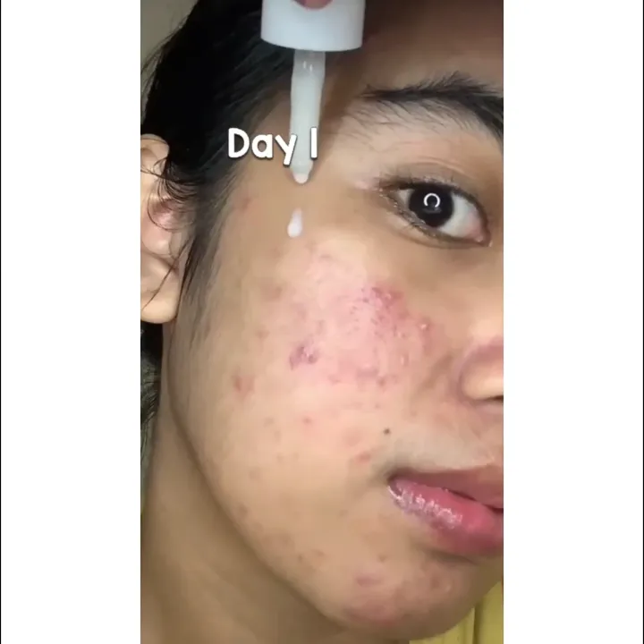 [Twin Pack] 2 PCS GLOW FX Acne Pure Serum - Serum Untuk Jerawat Meradang